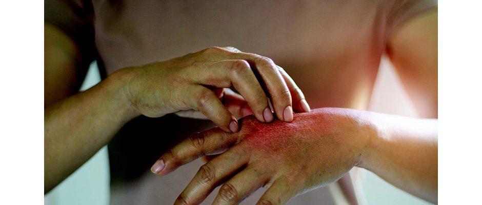 psoriasis 2023 - sphp news