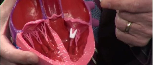 WNYT: Health Beat – Heart Valve Replacement